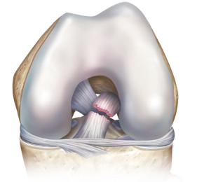 Acl tear 0 large